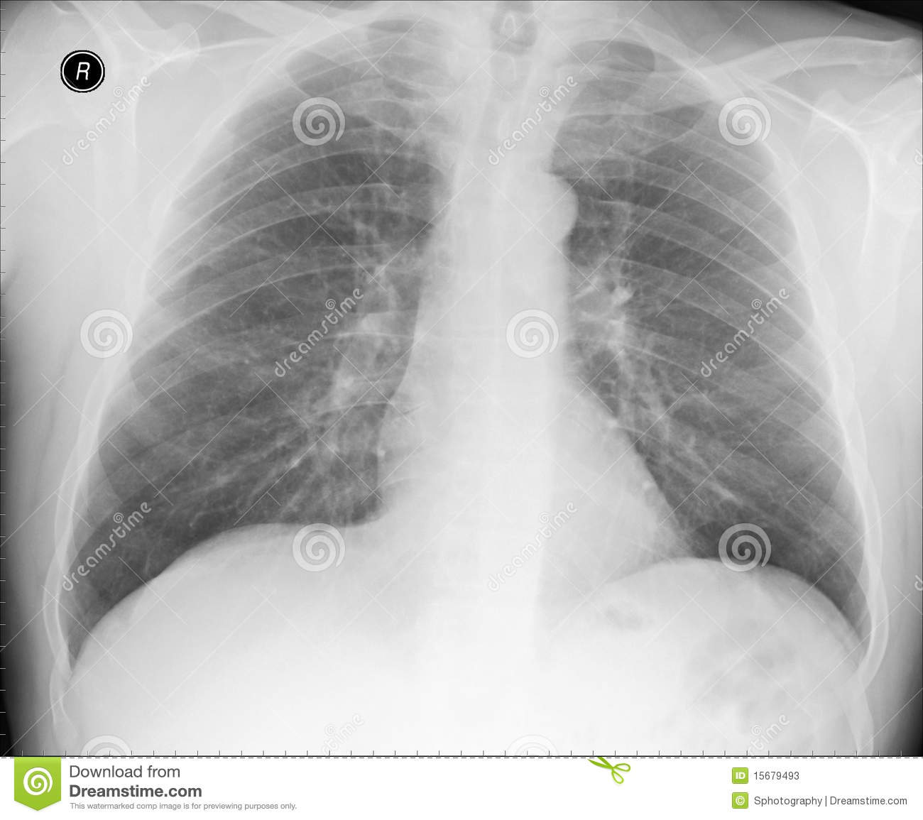 This Is Chest X Ray Of A Male Without Any Abnormalities