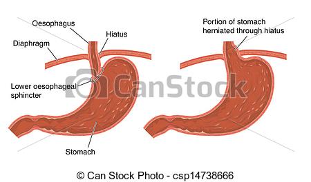 Art Vector Of Hiatus Hernia    Labeled Csp14738666   Search Clipart