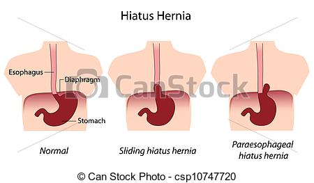 Eps8   Types Of Hiatus Hernia Eps8 Csp10747720   Search Clipart