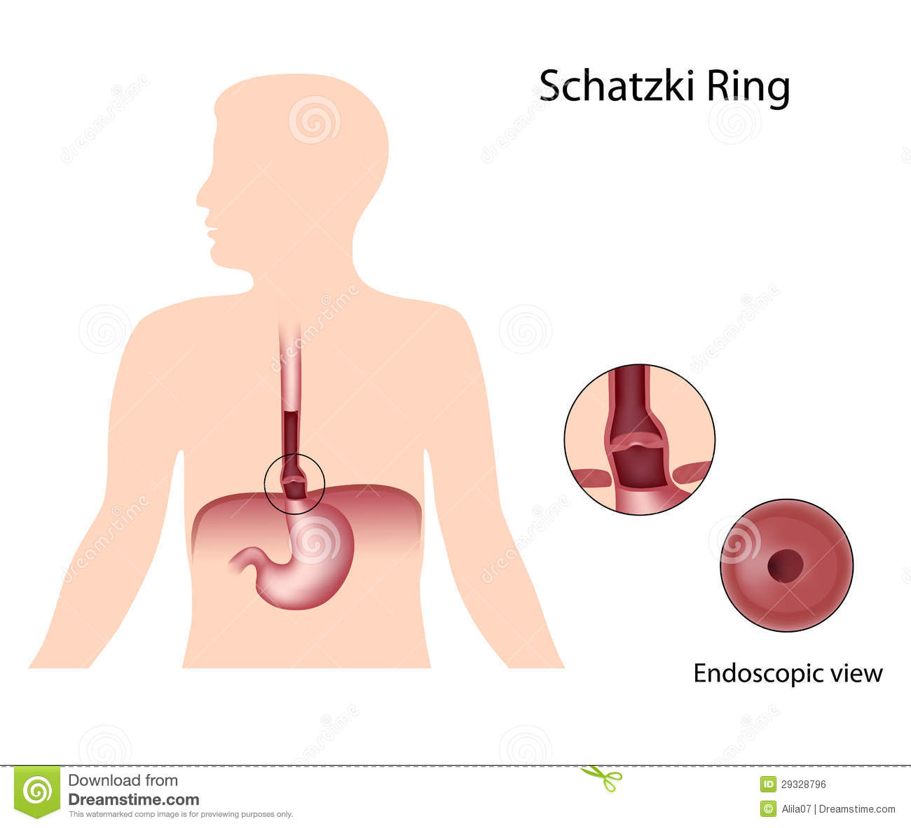 Schatzki Ring Royalty Free Stock Image   Image  29328796
