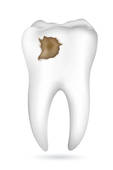Cavity In Tooth   Clipart Graphic