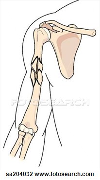 Clip Art   Comminuted  Multiple  Fracture Of The Humerus   Fotosearch