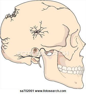 Clipart Of Lateral View Of Skull With Multiple Fractures Of Differing