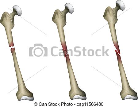 Bone Fracture Stock Photo Images  1459 Bone Fracture Royalty Free    