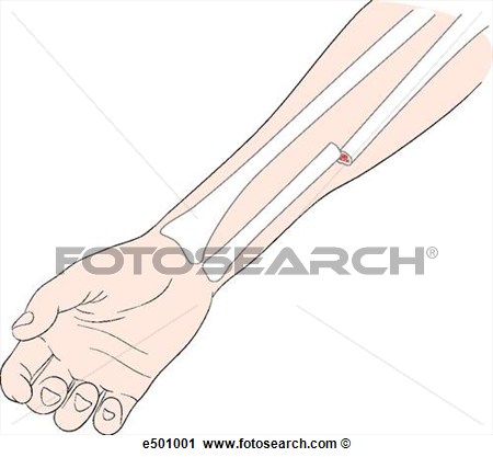 Clipart   Closed Fracture Of The Radius   Fotosearch   Search Clip Art    