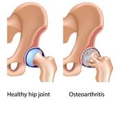 Painful Joints Total Hip Replacement Eps10