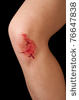 Horizontal Skinned Or Scraped Knee Stock Photo 78199156   Shutterstock