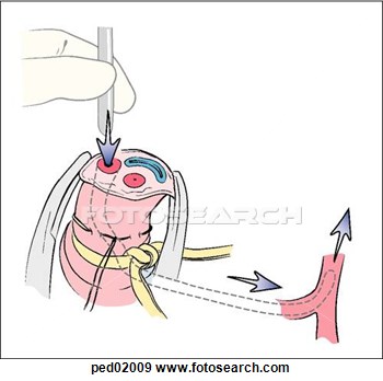 Umbilical Artery  Ped02009   Search Vector Clipart Drawings Print