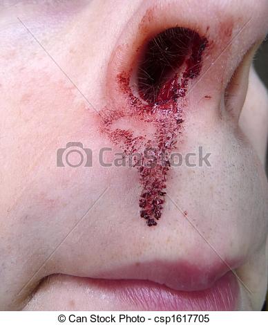 Stock Images Of Nose Bleed   Dried Up Nose Bleed Blood Csp1617705