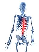 Lumbar Spine Osteoporosis Stock Illustrations   Gograph