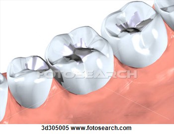 Close Up Of Filling In Tooth   Fotosearch   Search Clipart