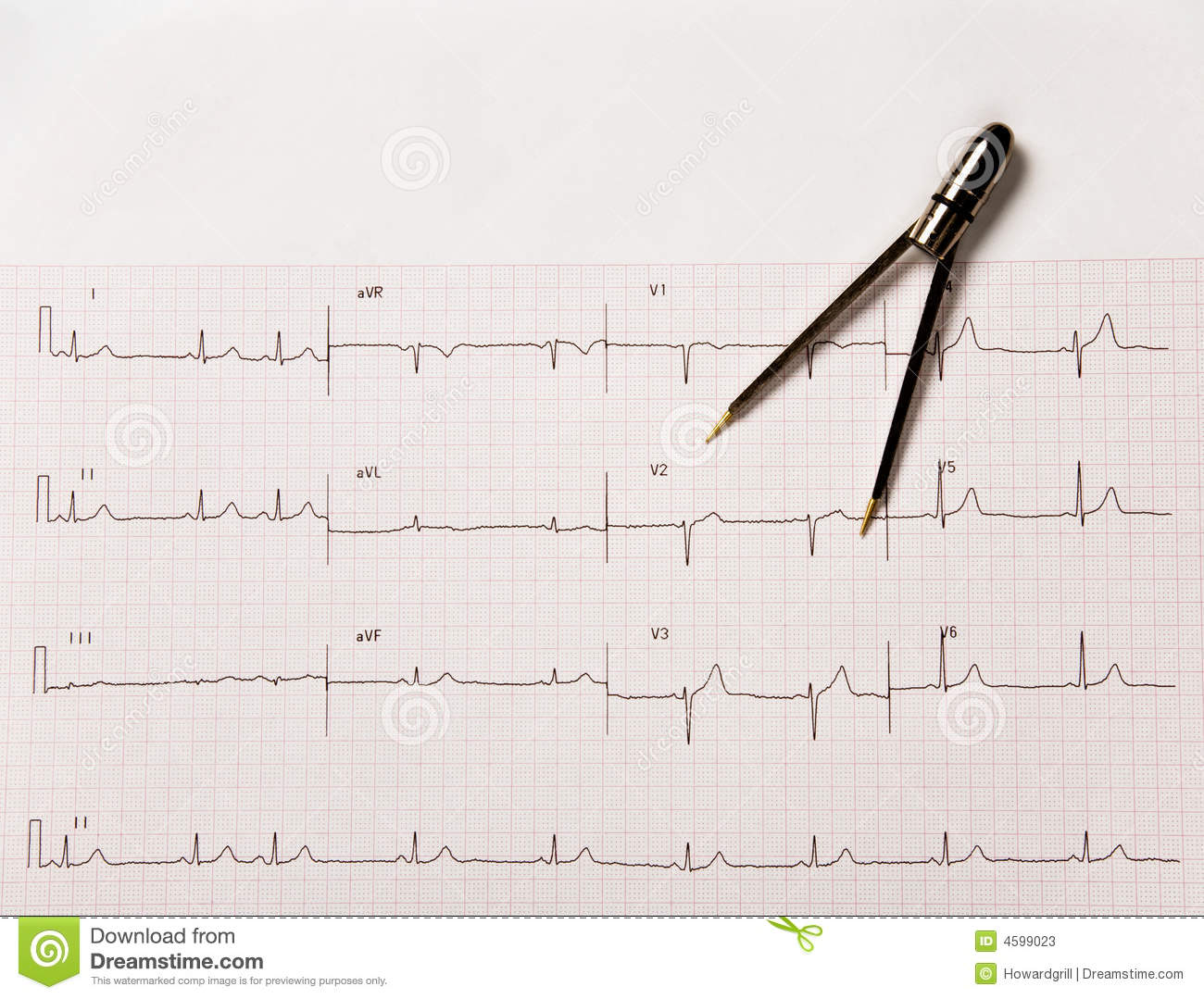 Electrocardiogram Or Ekg With Calipers Stock Photos   Image  4599023