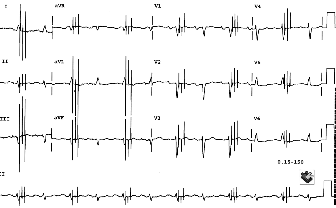 This Is A 12 Lead Electrocardiogram From A Middle Aged Man With End