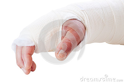 Broken Arm In A Splint And Cast  Fingers Are Discolored And Swollen