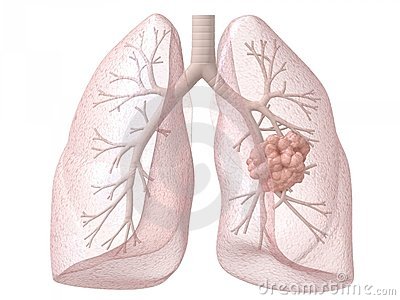 Lung Cancer Clip Art Lung Cancer