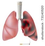 Lung Cancer From Smoking Vector   Download 278 Vectors  Page 1
