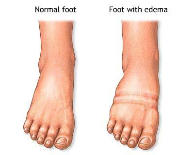 Swelling   Symptoms Causes Diagnosis Swelling Treatment