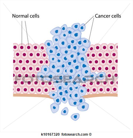 Clipart   Cancer Cells In A Growing Tumor  Fotosearch   Search Clip    