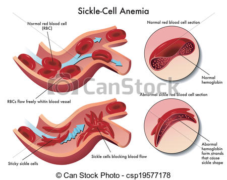 Sickle Cell Anemia   Csp19577178