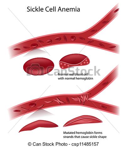 Sickle Cell Disease Eps10   Csp11485157