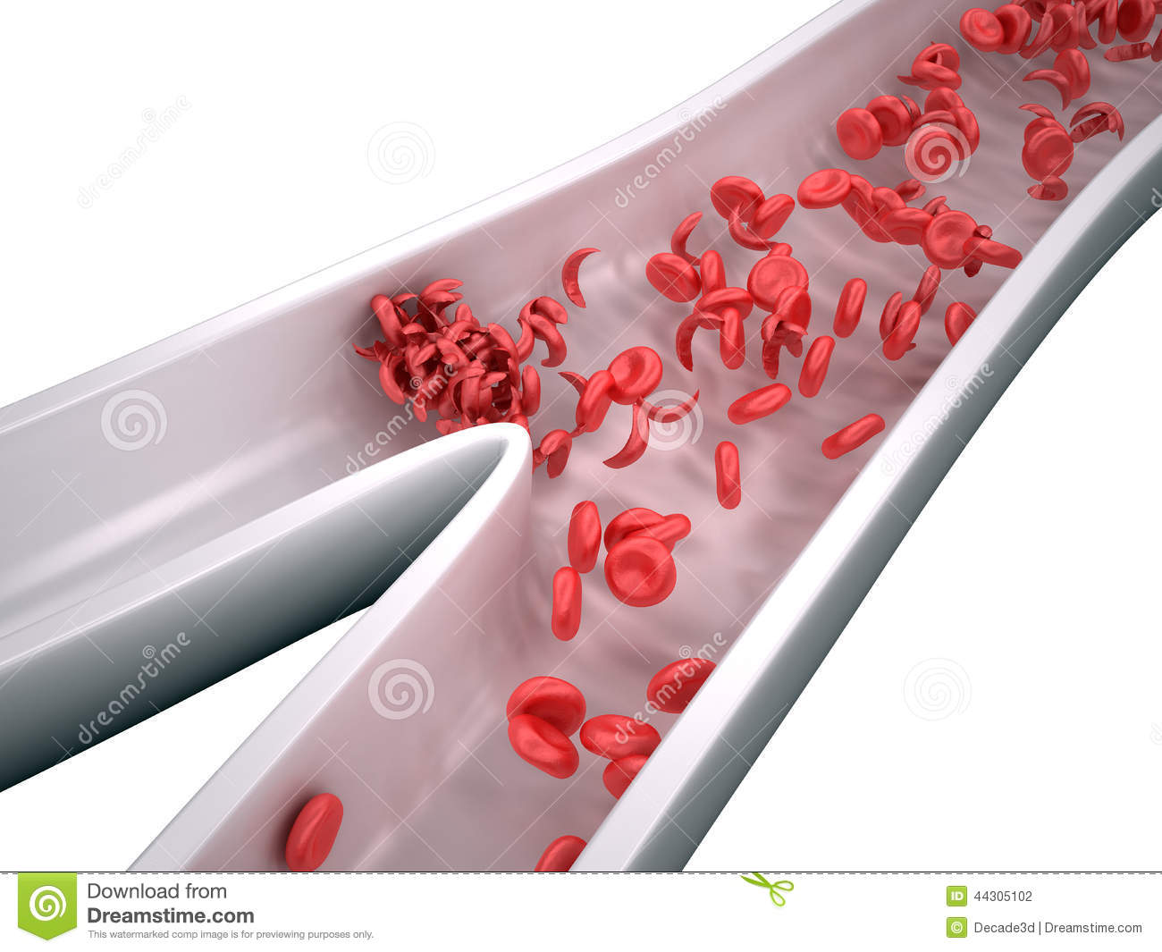Sickle Cells Blocking Blood Flow   Isolated On White Stock    