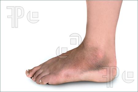 Woman With Broken Foot Pics  High Resolution Photograph At Featurepics