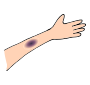 Bruise Outline For Classroom   Therapy Use   Great Bruise Clipart