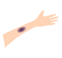 Bruise Picture For Classroom   Therapy Use   Great Bruise Clipart