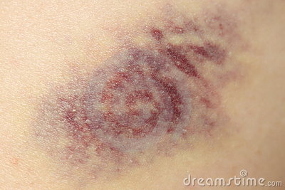 Bruise Stock Photo   Image  12867390