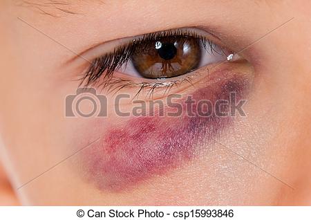 Stock Photo   Boy With Bruise   Stock Image Images Royalty Free    