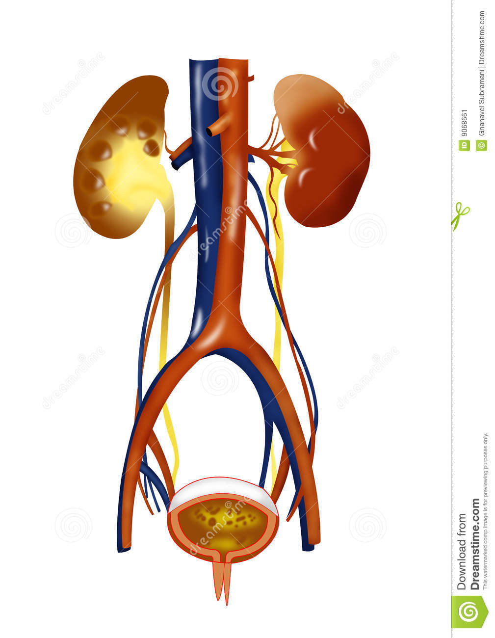 Kidney Transplant Clipart Kidney