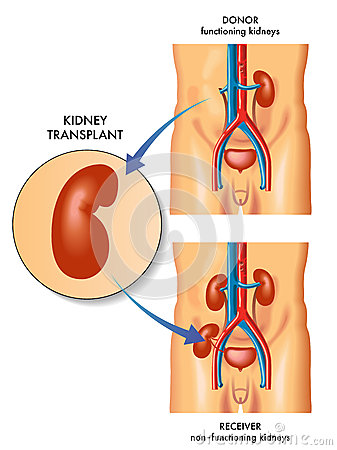 Kidney Transplant Stock Image   Image  25563661