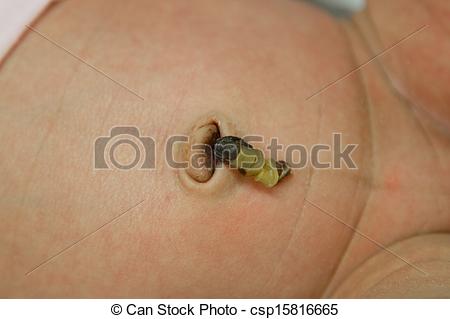 Stock Image Of The Dried Stump Of An Umbilical Cord In A Newborn Babys    