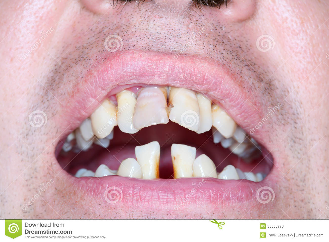 Rotten And Crooked Teeth Of Men  Crooked Teeth Can Be Sign Of Running