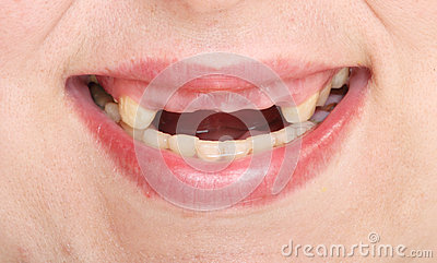 Rotten Teeth  Stock Photo   Image  35981550