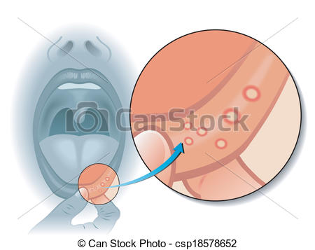 Vector   Mouth Sores   Stock Illustration Royalty Free Illustrations