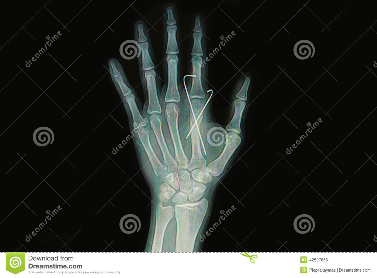 Film X Ray Of Hand Fracture   Show Fracture Metacarpal Bone Insert