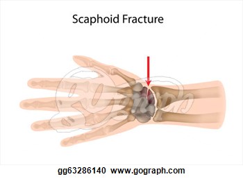 Fracture Most Common Of Carpal Bone Fracture A Sport Injury Clipart