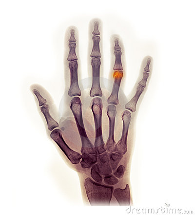 Hand X Ray Clipart Hand X Ray Showing Fracture     