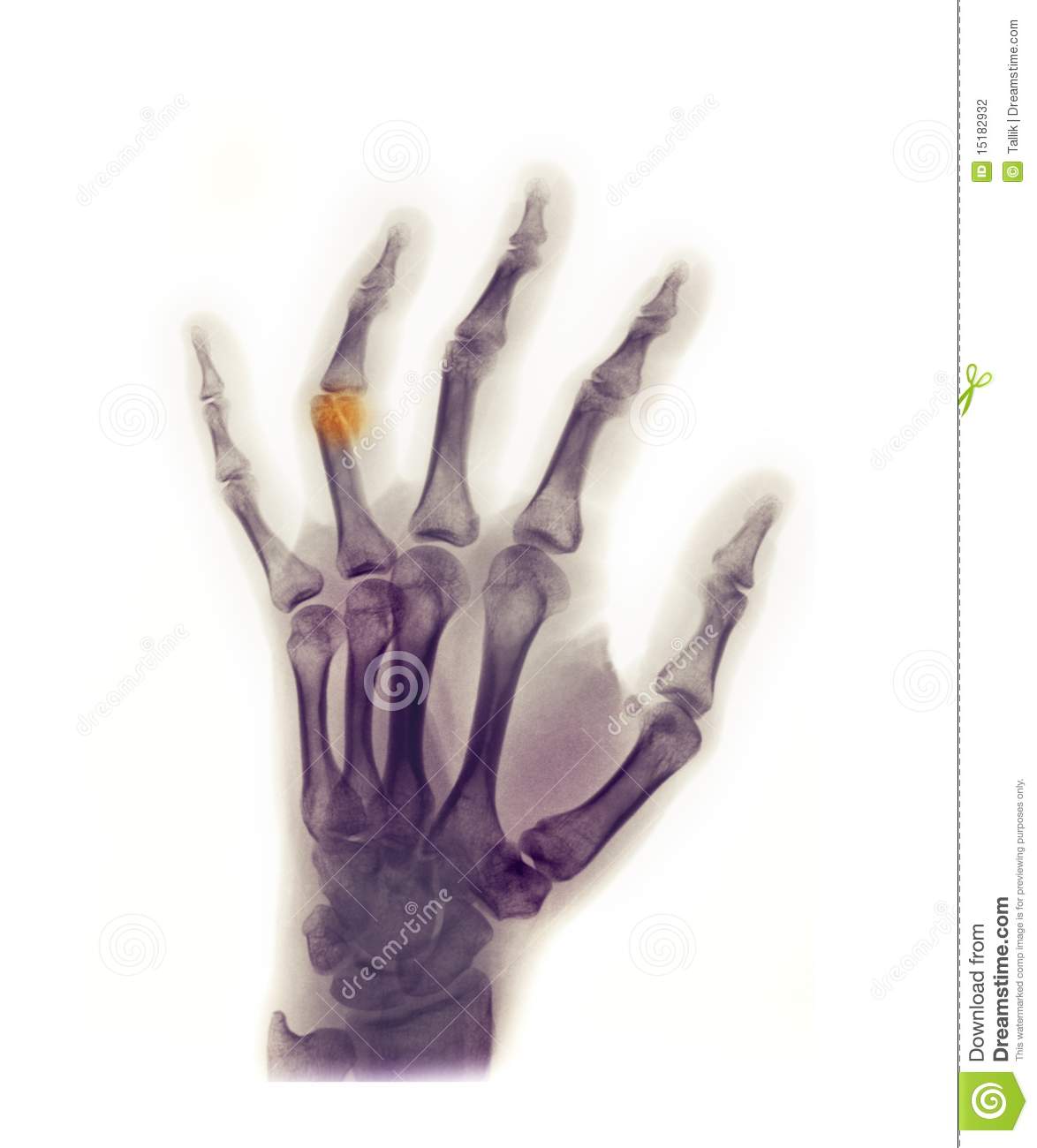 Hand X Ray Of A 23 Year Old Female Showing A Fracture Of The Distal    