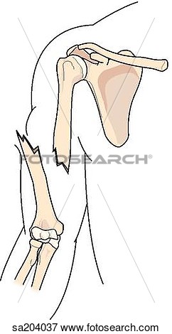 Open  Compound  Fracture Of The Humerus  Sa204037   Search Eps Clipart    