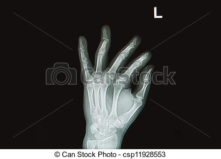 Photo   Hand And Finger X Ray Image Show Hand And Finger Fracture    