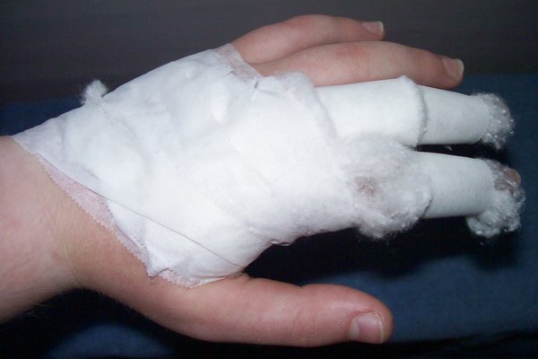 Bandaged Hand Pictures
