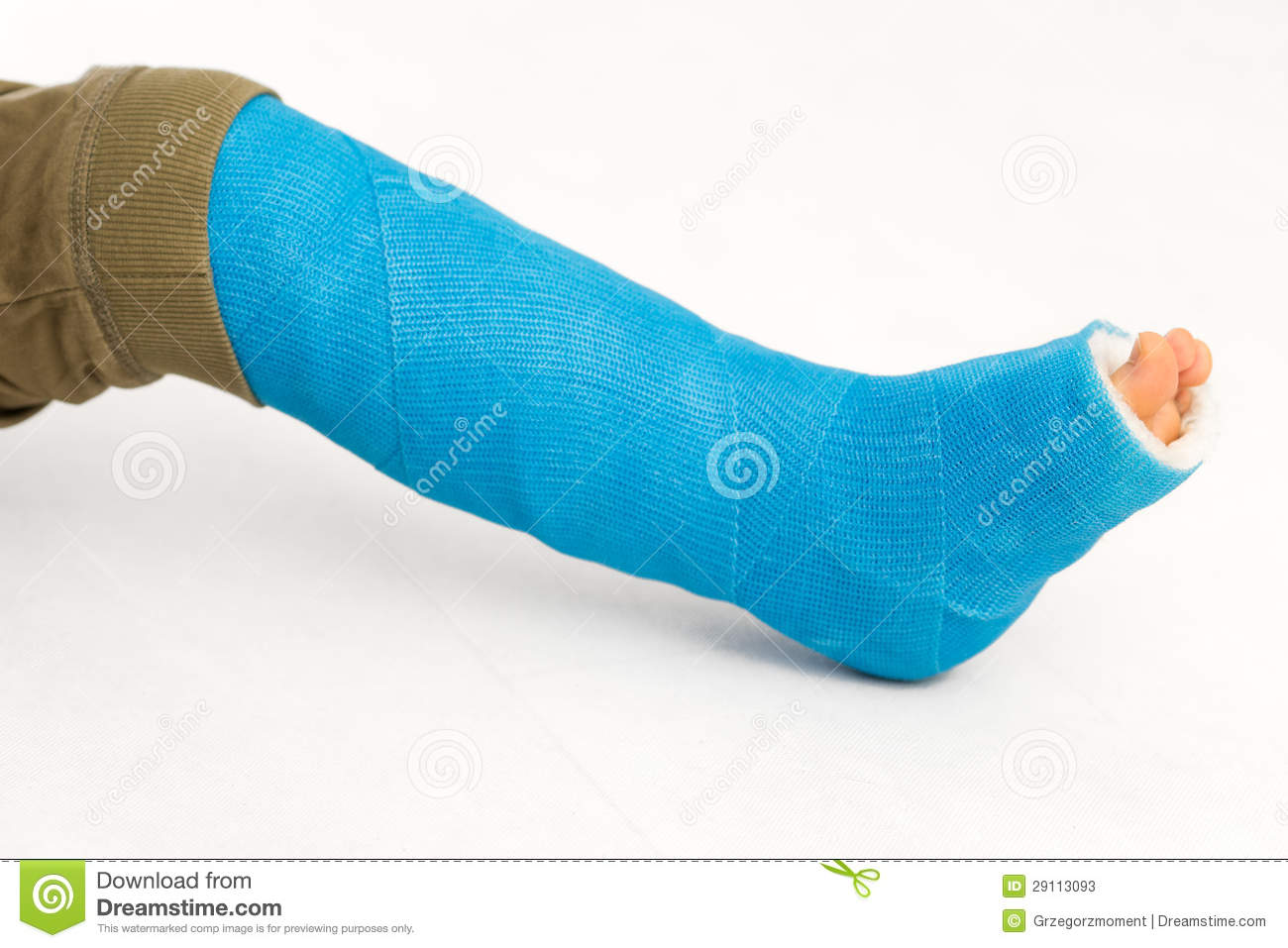 Broken Human Leg In Cast   Child And Boy Stock Photos   Image