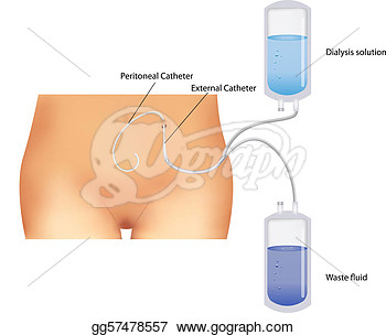     Procedure  Used For The Renal Insufficiency    Clip Art Gg57478557