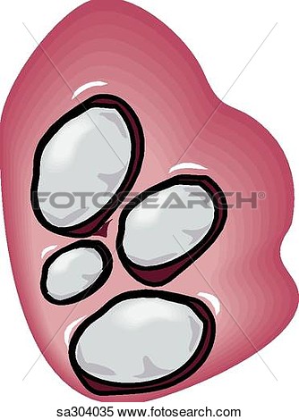 Stock Illustration Of Type Of Kidney Stone  Sa304035   Search Clipart