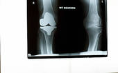     Ray A Hip X Ray A X Ray Of A Knee Joint An X Ray Of A Knee Replacement