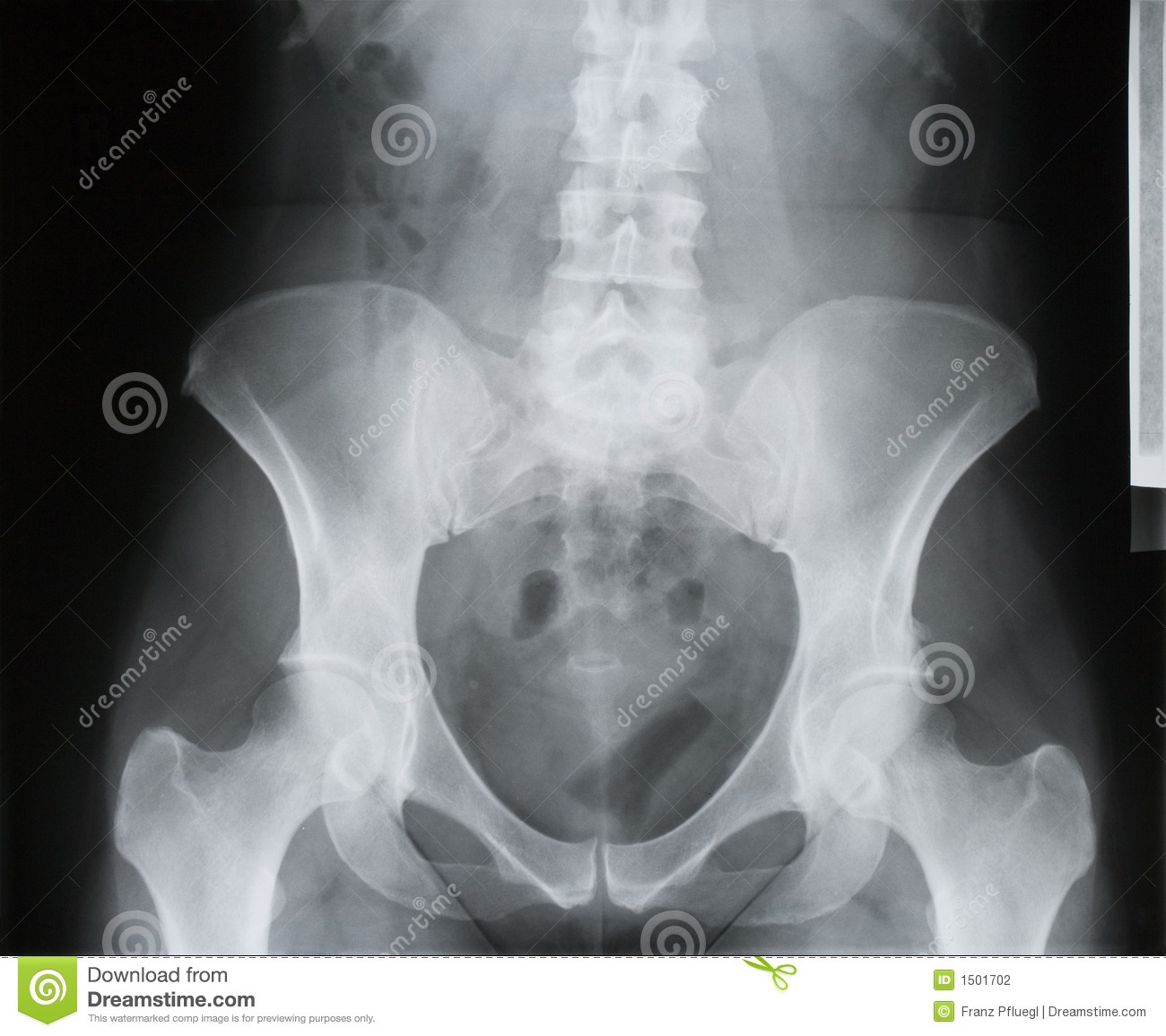 Stock Photography  Backbone Pelvis Socket Of Hip Joint Thigh Bone X