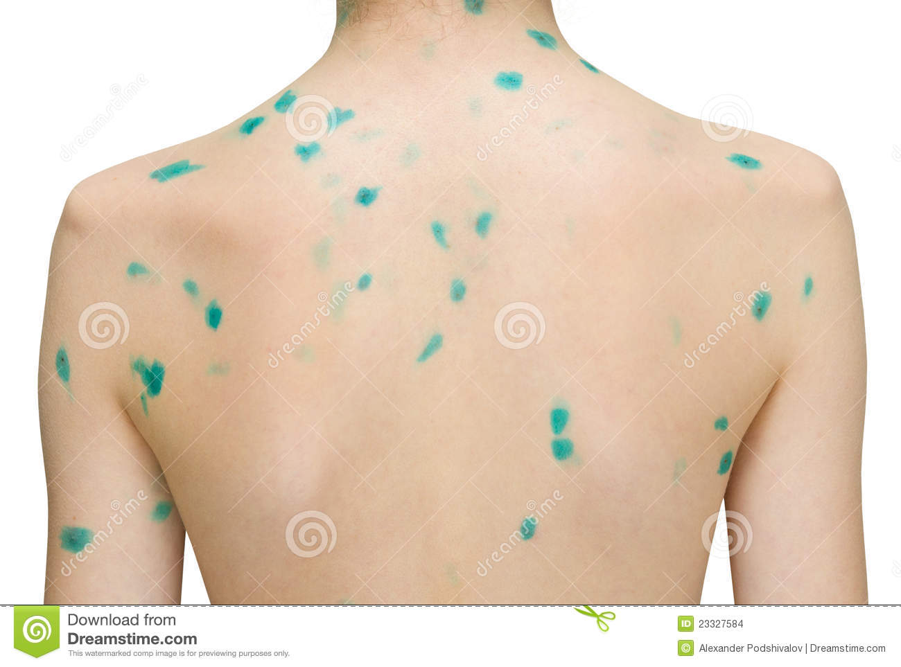 Chicken Pox Stock Images   Image  23327584