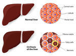 Cirrhosis Of The Liver And Normal Liver Structure Of The Liver Vector